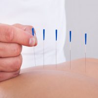 akupunktur